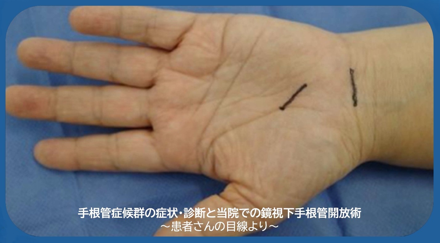 手根管症候群の診断と治療 ～患者さんの目線より～