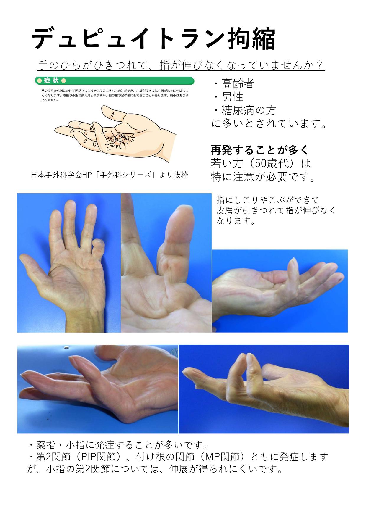 頻度の多い手の外科疾患 - 手根管症候群など手の病気を治療する 茨城県 